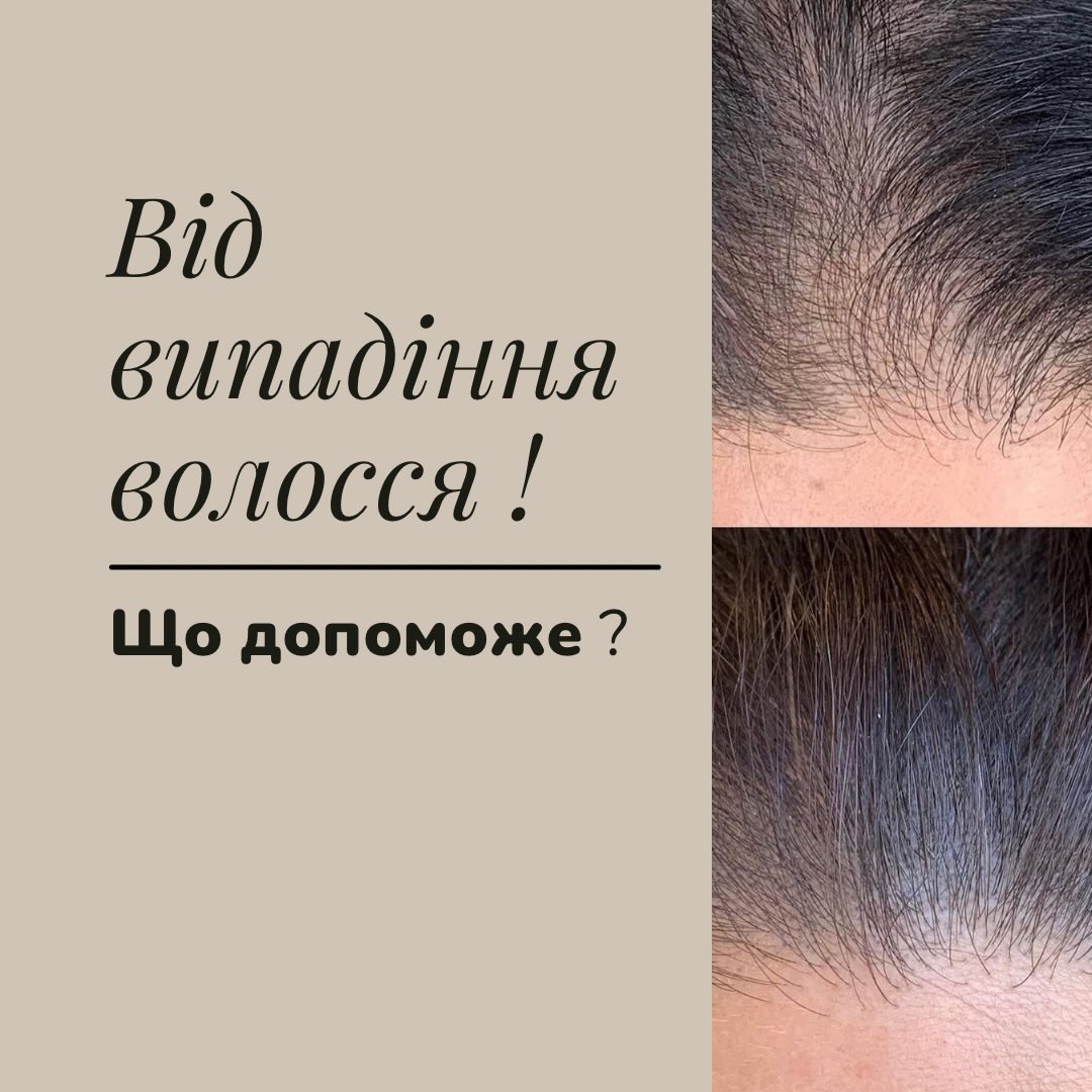Від випадіння волосся 👩🔬🧪 1)